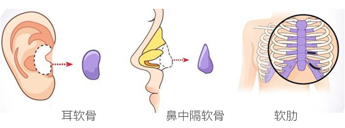 鼻小柱整形