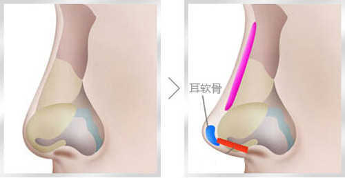 鼻尖塑形