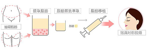 自體脂肪豐太陽穴