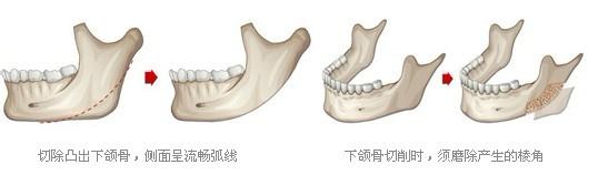 下頜角整形