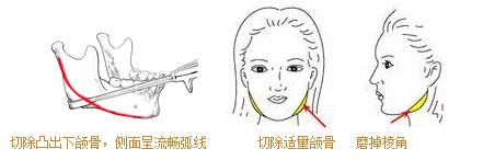 下頜角整形