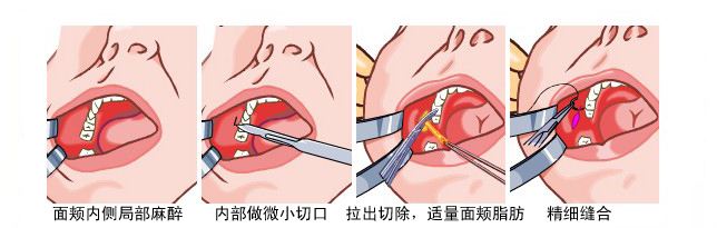 頰脂肪墊