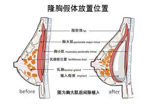 隆胸假體取出