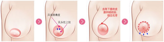 乳房下垂矯正