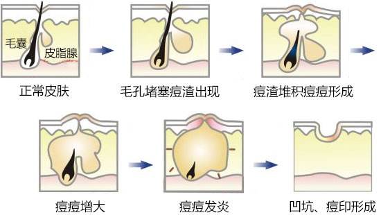 痘印