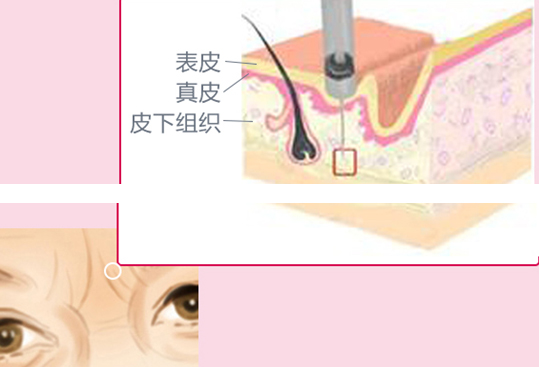 面部除皺