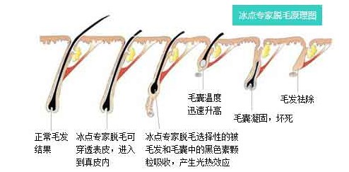 脫腋毛